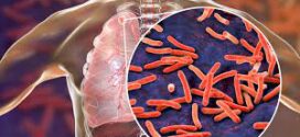 Santé : La prévention des futures pandémies passe par la lutte contre la tuberculose, selon un nouveau rapport